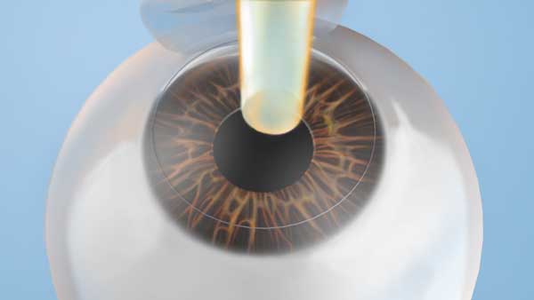 LASIK procedure Step 3