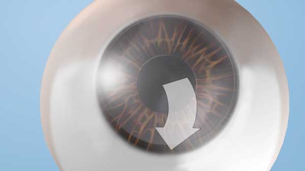 LASIK procedure Step 4