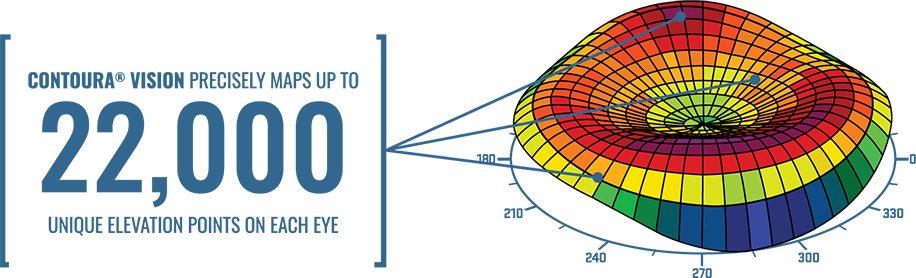 Contoura Vision Precisely Maps Up To 22,000 Unique Elevation Points on Each Eye