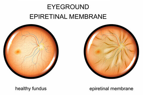Epiretinal Membrane diagram