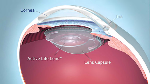 Active Life Lens Procedures