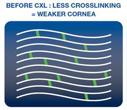 Before CXL: Less Crosslinking = Weaker Cornea