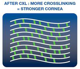 After CXL: More Crosslinking = Stronger Cornea