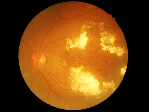 Retina scan of diabetic retinopathy