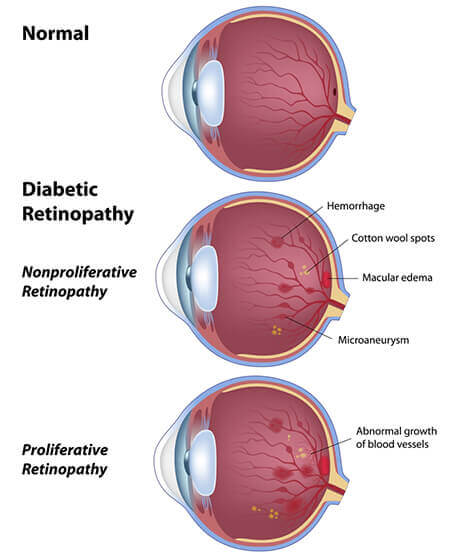 Medical diagram of the stages of Diabetic Retinopathy