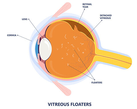 Illustration of floaters on retina