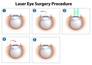 how-safe-is-lasik-procedure