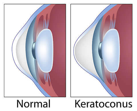 Diagram of Keratoconus