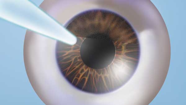 Step 1a: A tiny opening is created on the surface of the eye using a femtosecond laser.