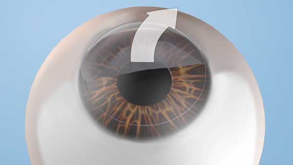 Step 1b: The “flap” is gently pulled back to allow access to the cornea, the area that needs to be reshaped.