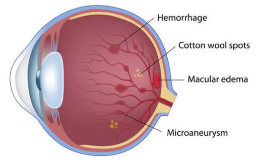Nonproliferative Retinopathy