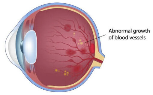 Proliferative Retinopathy