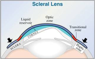 Scleral Lens Houston