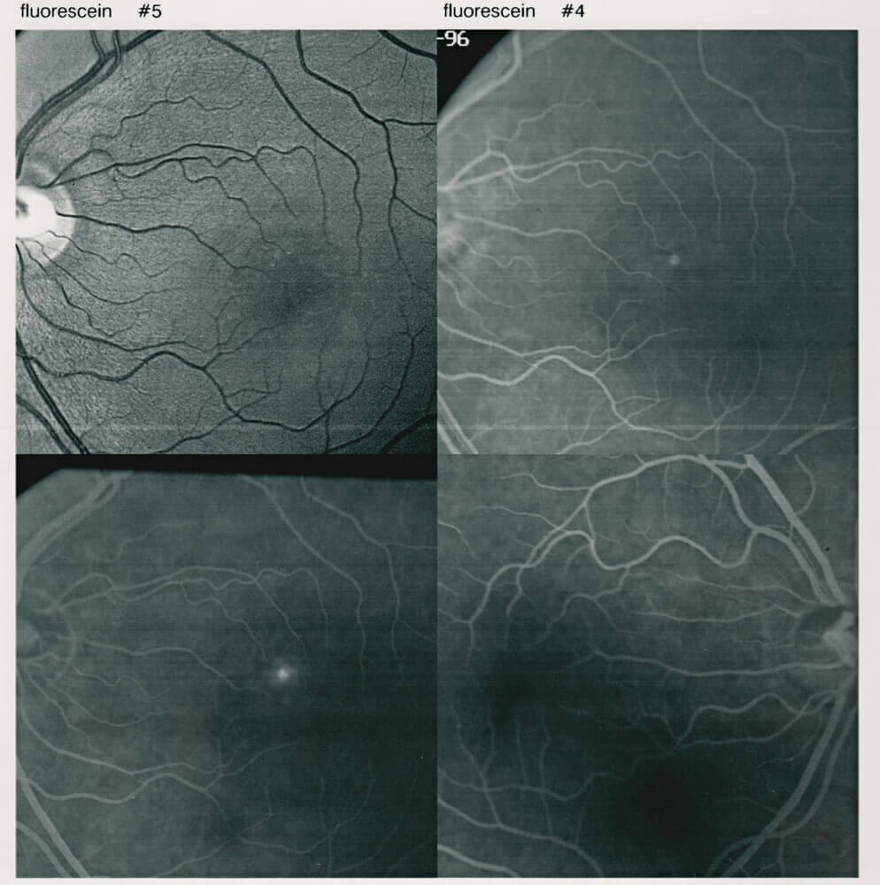 Left eye with Central Serous Chorioretinopathy