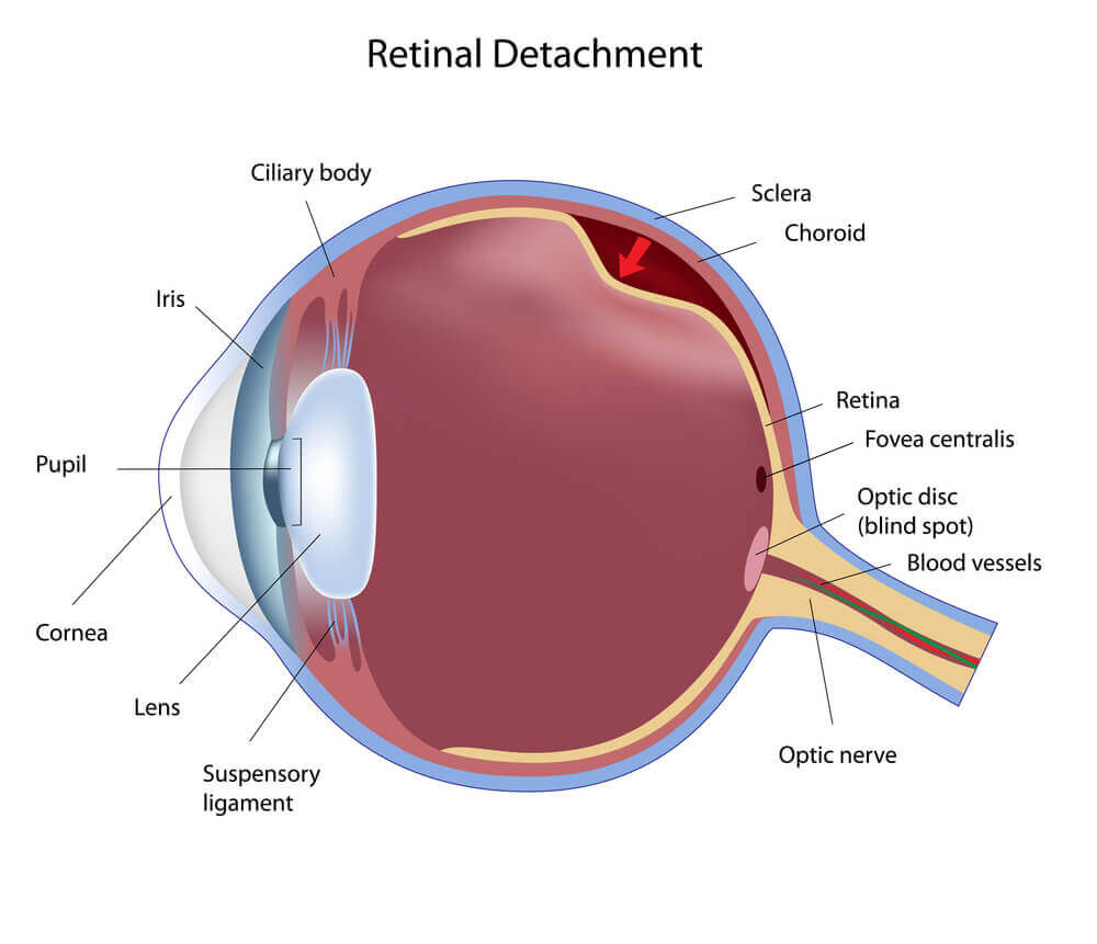 Retinal Detachment Illustration
